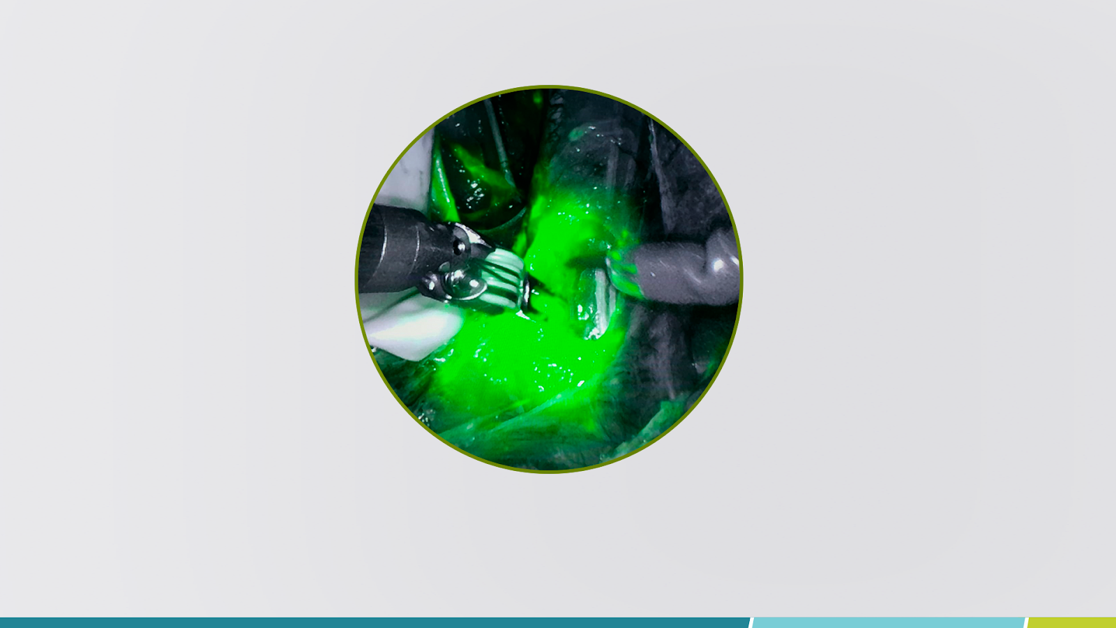 Verde de indocianina aumenta a eficácia das cirurgias colorretais minimamente invasivas