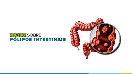 5 Fatos sobre pólipos intestinais