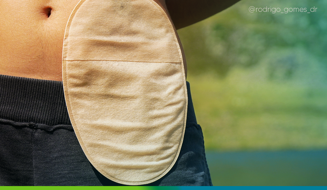 Ileostomia e colostomia: você sabe qual a diferença?