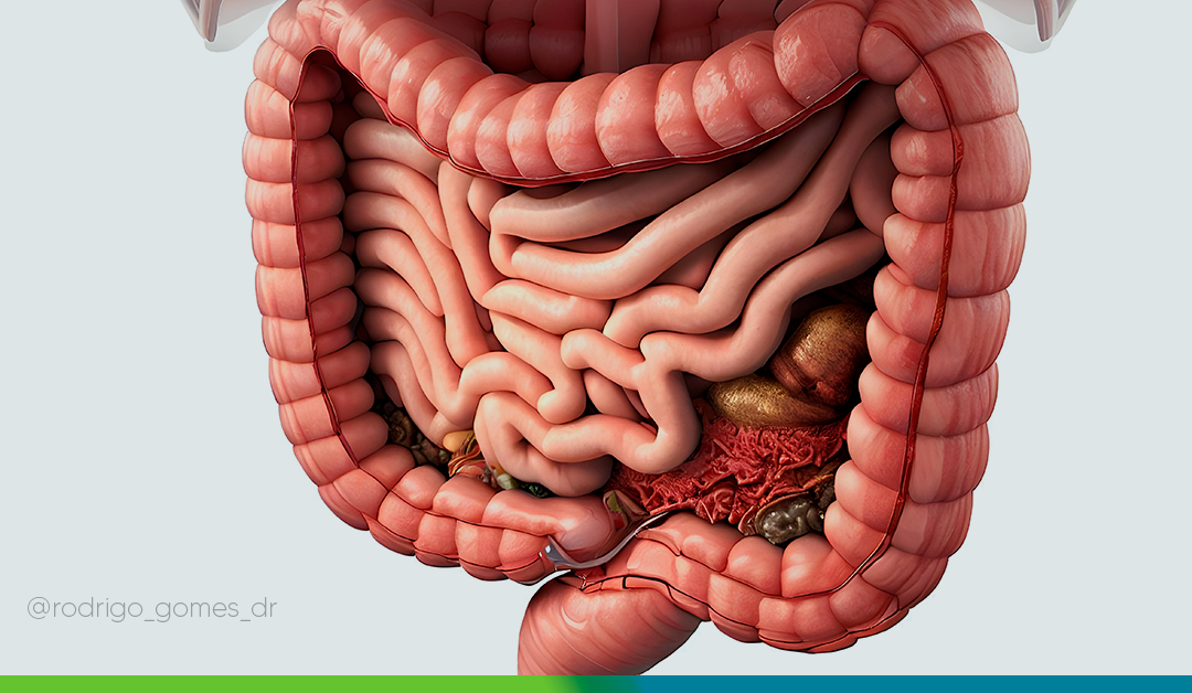 5 principais dúvidas sobre a HIPEC ou Quimioterapia Intraperitoneal Hipertérmica